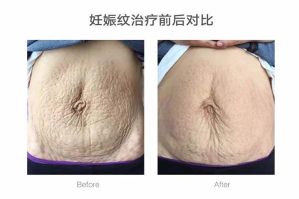 碧无痕妊娠修复