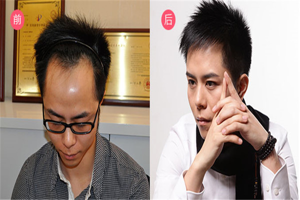 惠民植发加盟