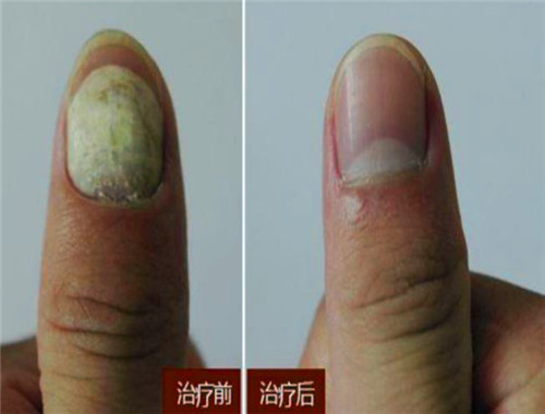 甲健丽灰指甲