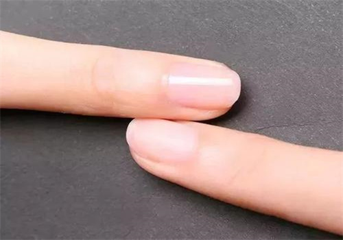 甲甲美灰指甲