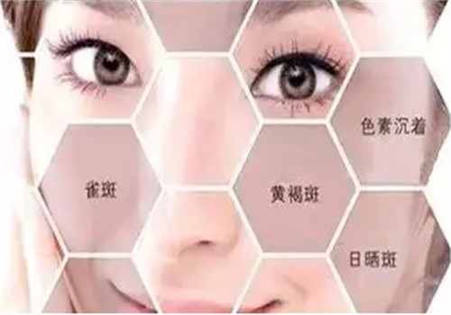 欧依然靶向祛斑