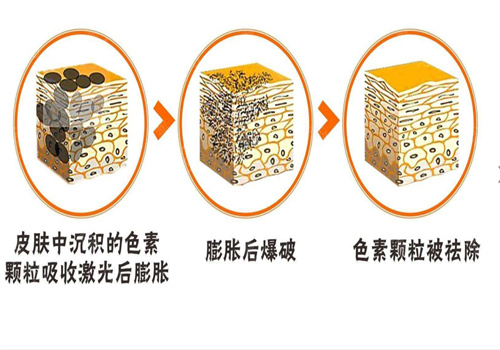 欧依然靶向祛斑