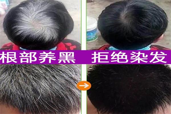 黑桃a白发转黑发