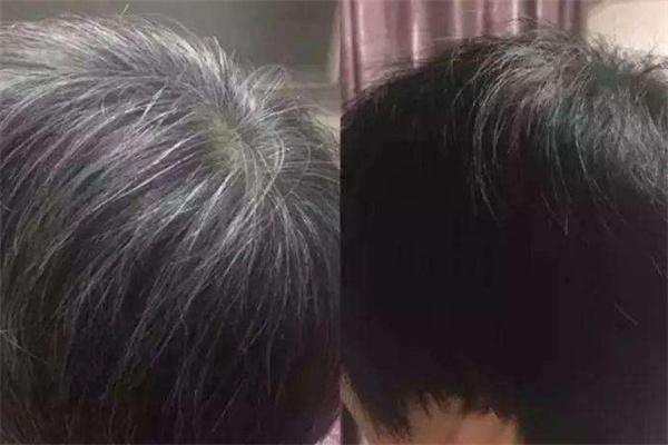 黑桃a白发转黑发