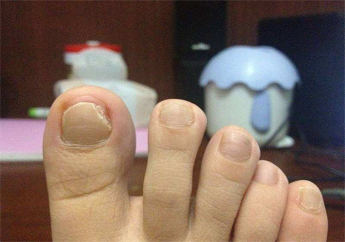 民医堂灰指甲
