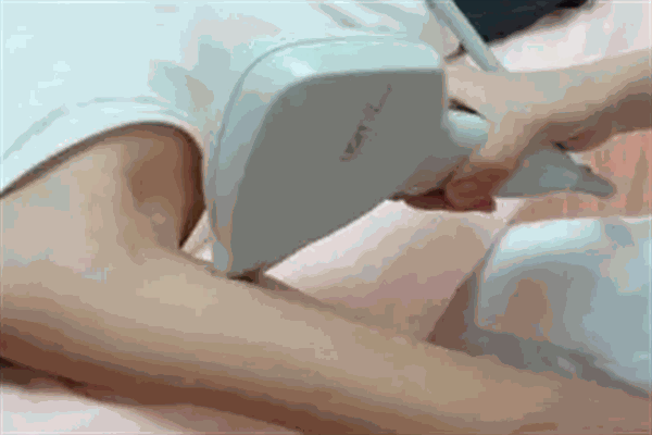 每怡脱毛加盟