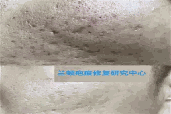 兰顿无痕祛疤