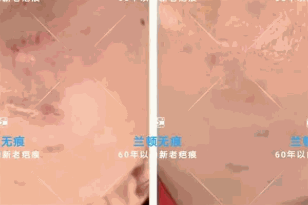 兰顿无痕祛疤