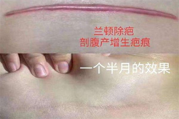 兰顿无痕祛疤