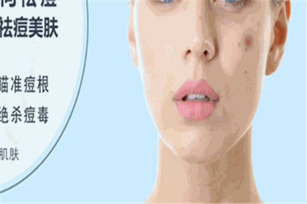 苗坊净颜专业祛痘