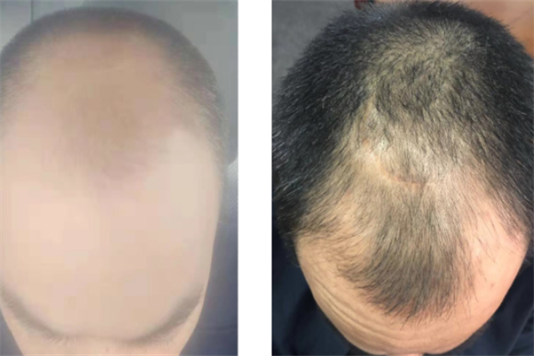 顶上世家止脱生发养发