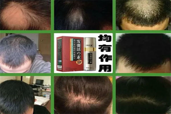 顶上世家止脱生发养发