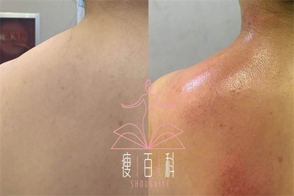 瘦百科减肥