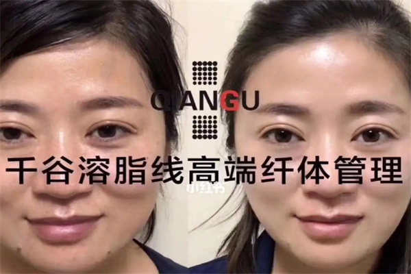 千谷溶脂线