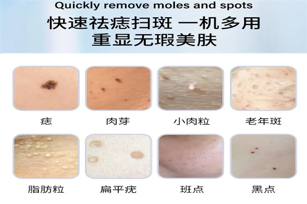 丽红姐点痣点斑加盟